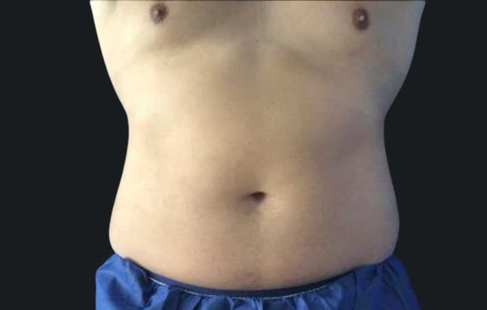 Coolsculpting® ELITE Case 22 Before Image