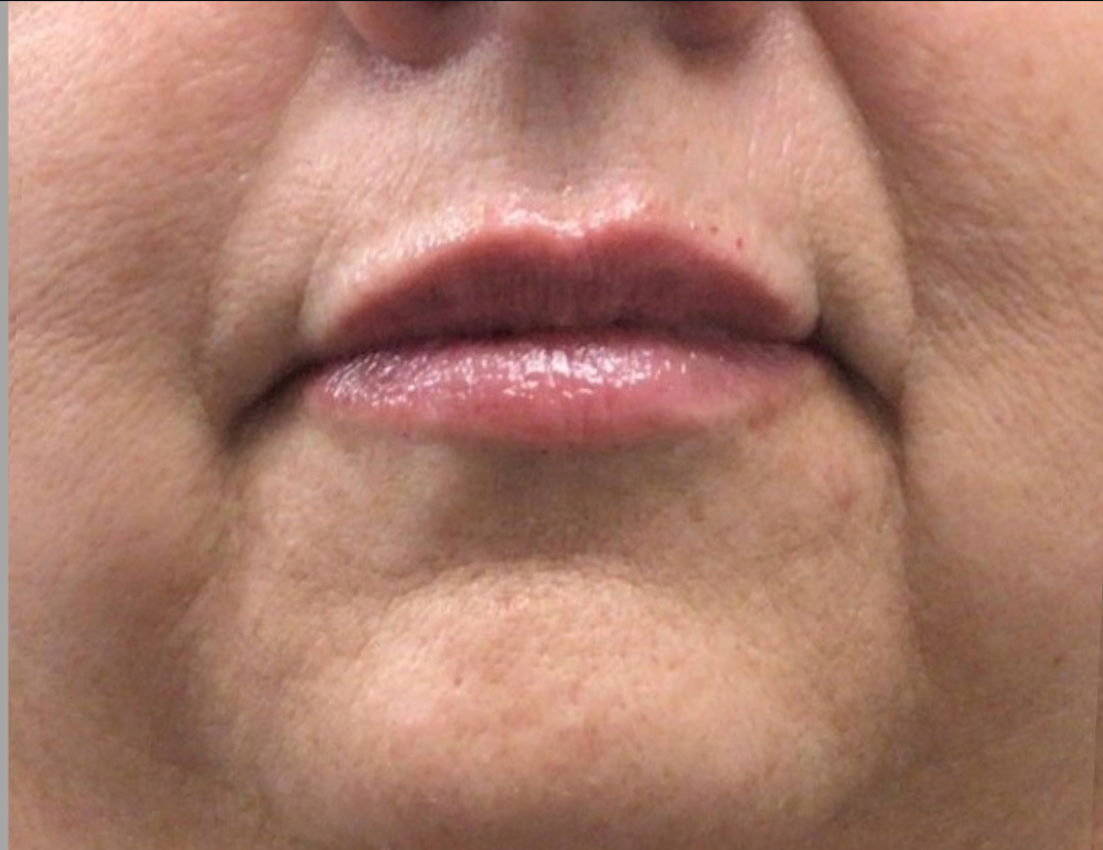 Lip Injections Case 22 After Image