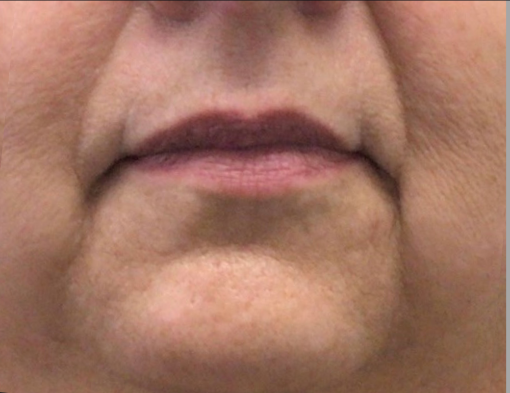 Lip Injections Case 22 Before Image