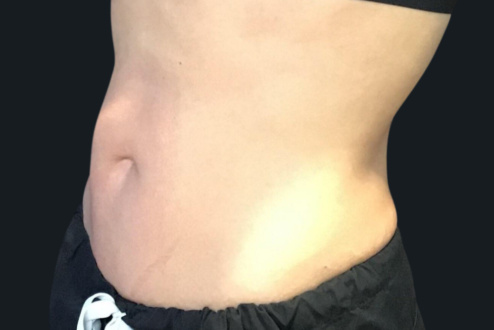 Coolsculpting® ELITE Case 23 After Image
