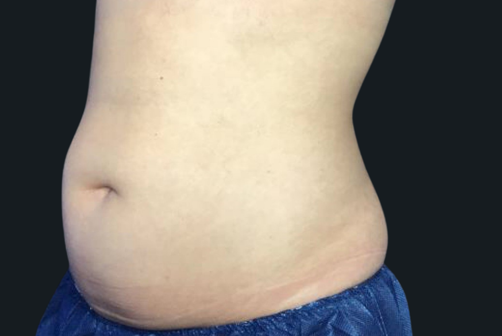 Coolsculpting® ELITE Case 23 Before Image
