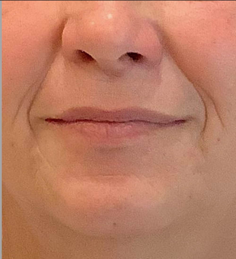 Dermal Fillers Case 24 After Image
