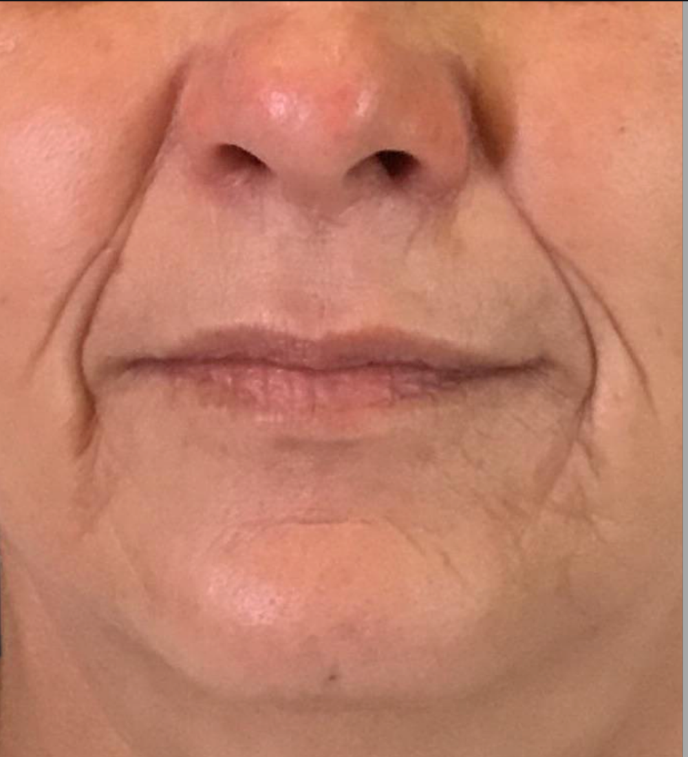 Dermal Fillers Case 24 Before Image
