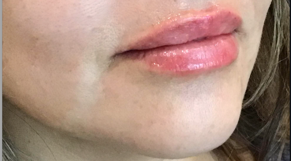 Lip Injections Case 26 After Image