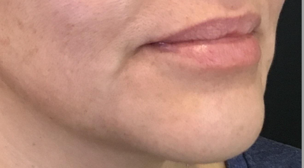 Lip Injections Case 26 Before Image