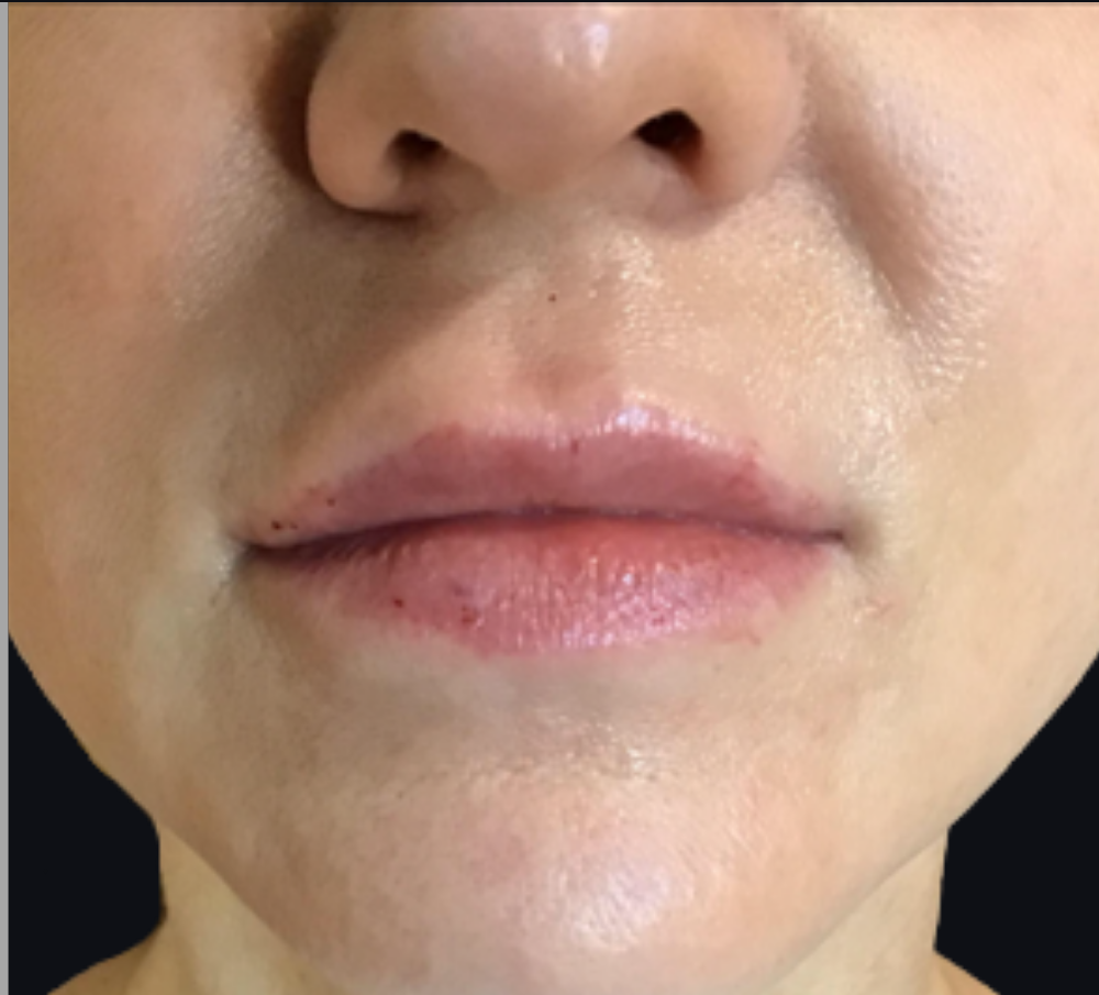 Lip Injections Case 27 After Image