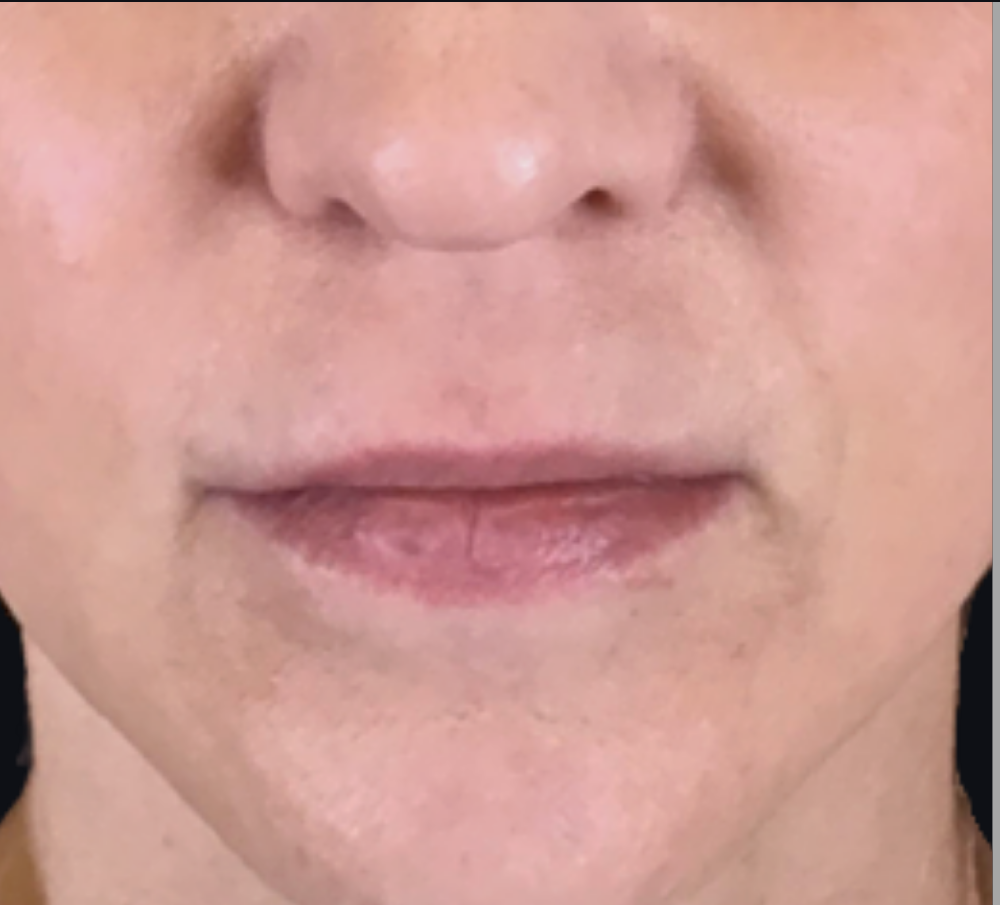 Lip Injections Case 27 Before Image