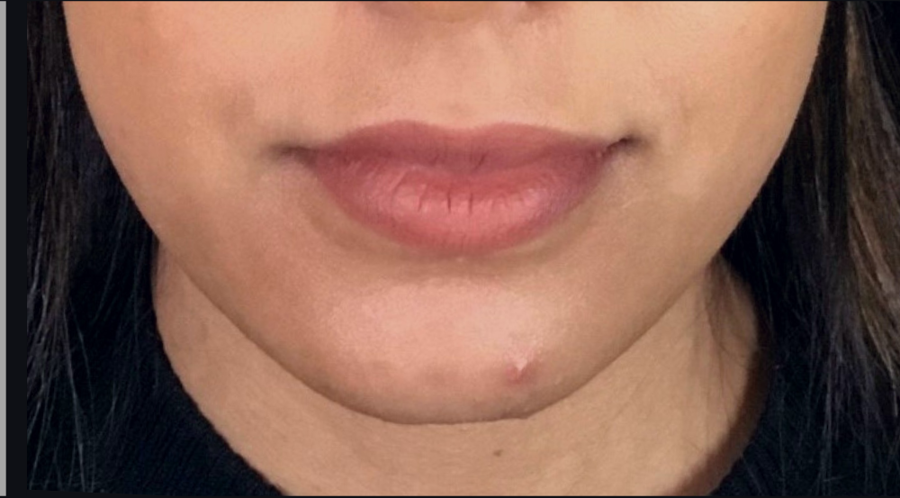 Dermal Fillers Case 27 After Image