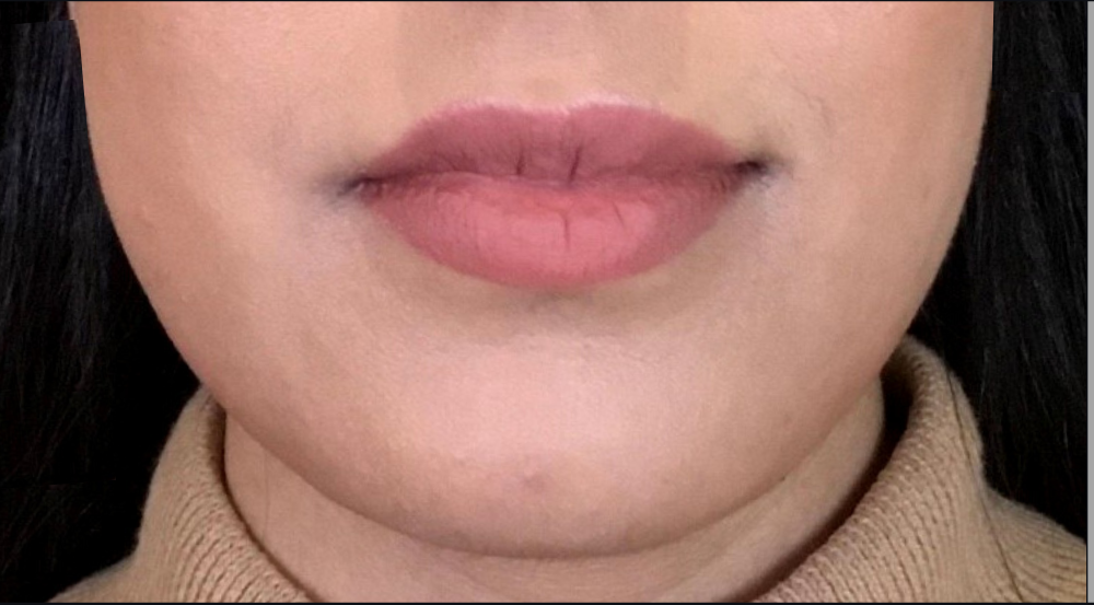 Dermal Fillers Case 27 Before Image