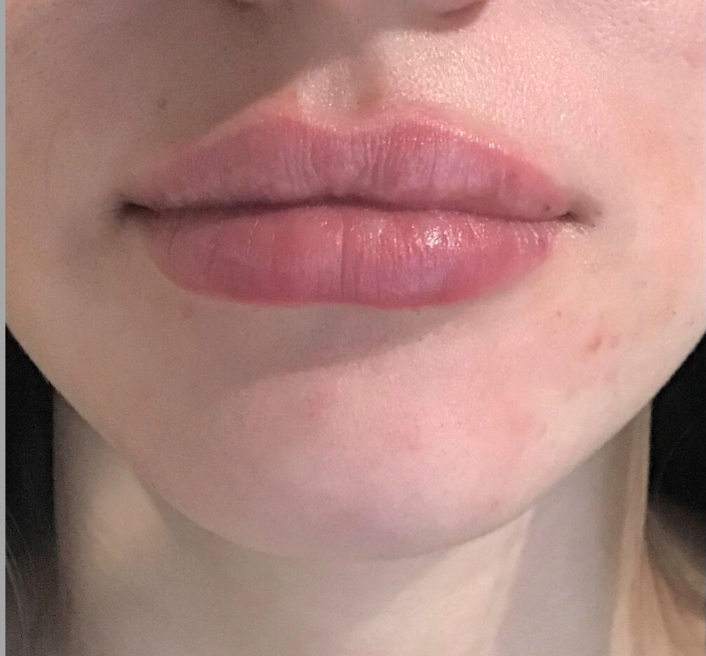 Lip Injections Case 28 After Image