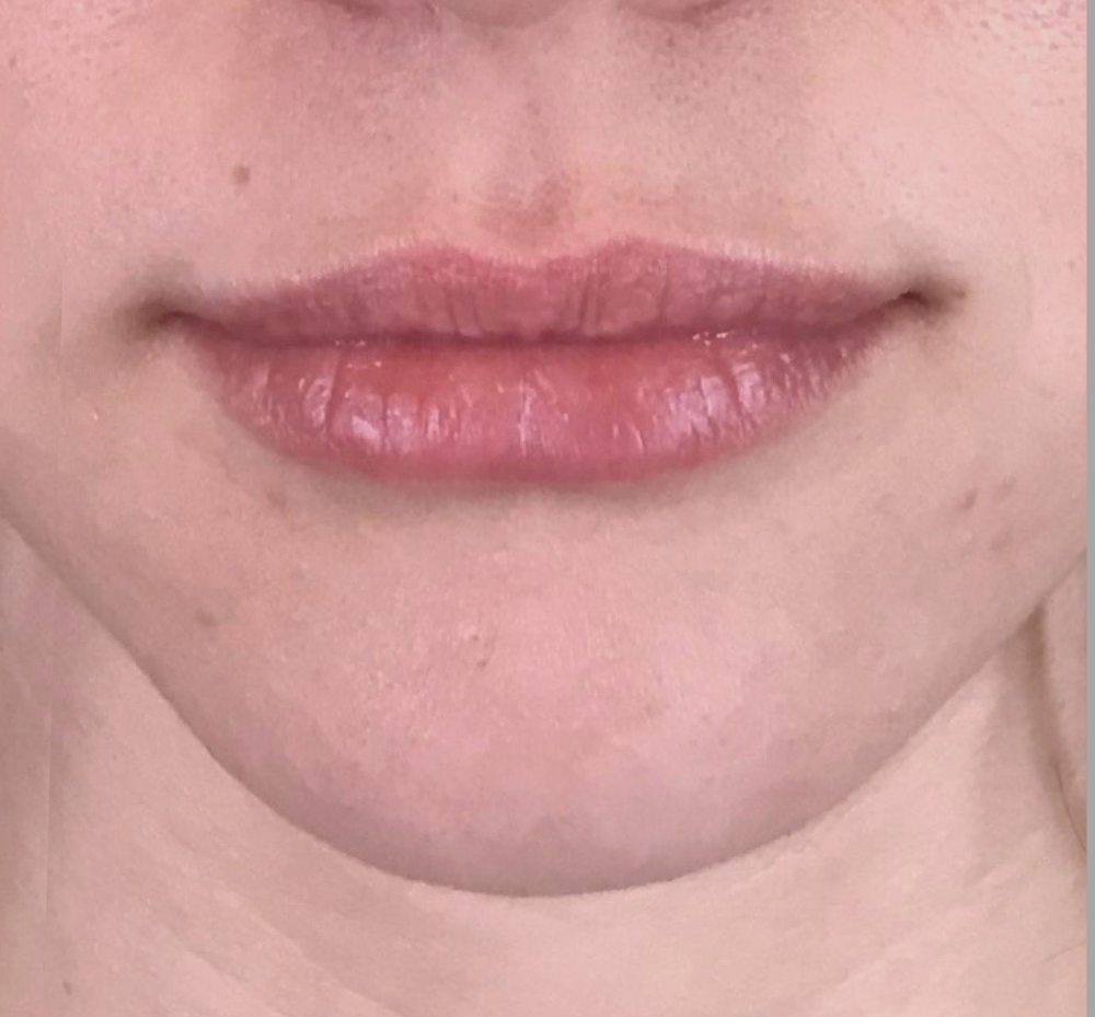Lip Injections Case 28 Before Image