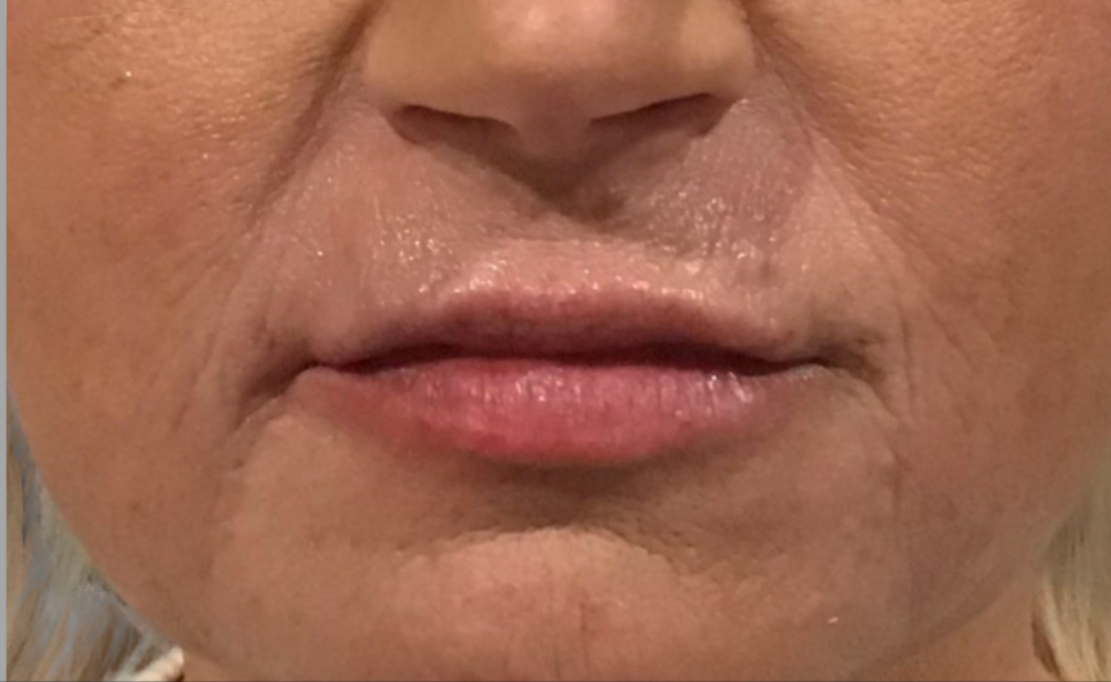 Dermal Fillers Case 28 After Image