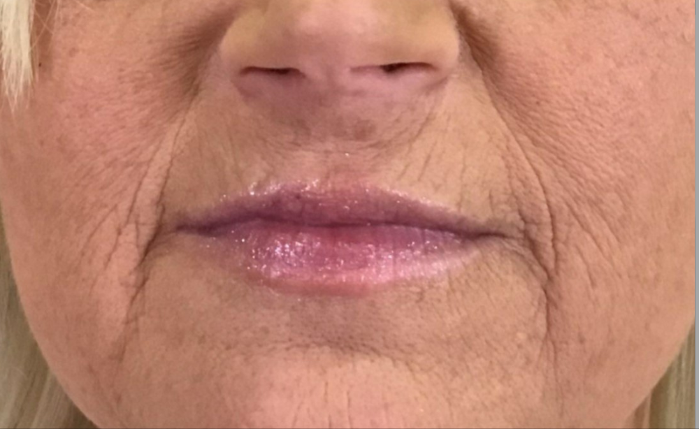 Dermal Fillers Case 28 Before Image