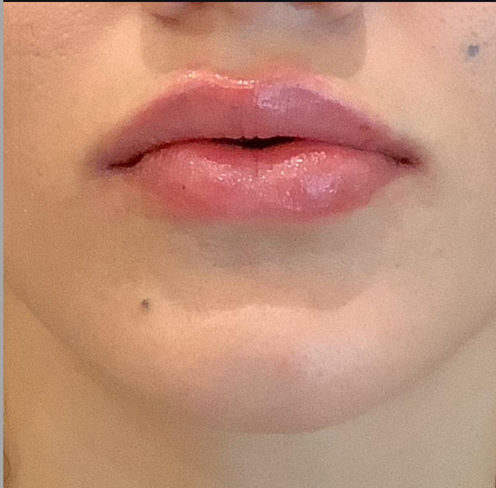 Lip Injections Case 29 After Image