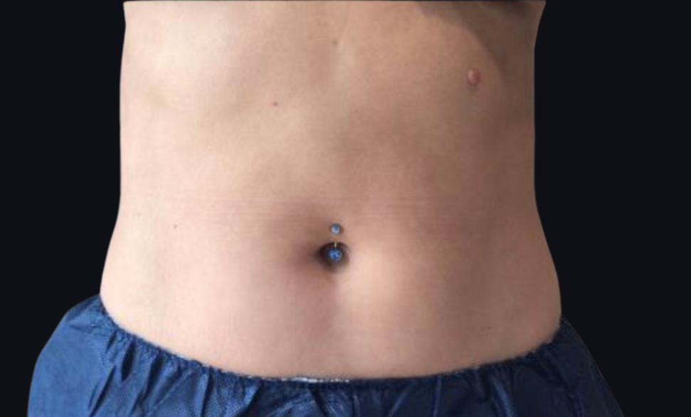 Coolsculpting® ELITE Case 29 After Image