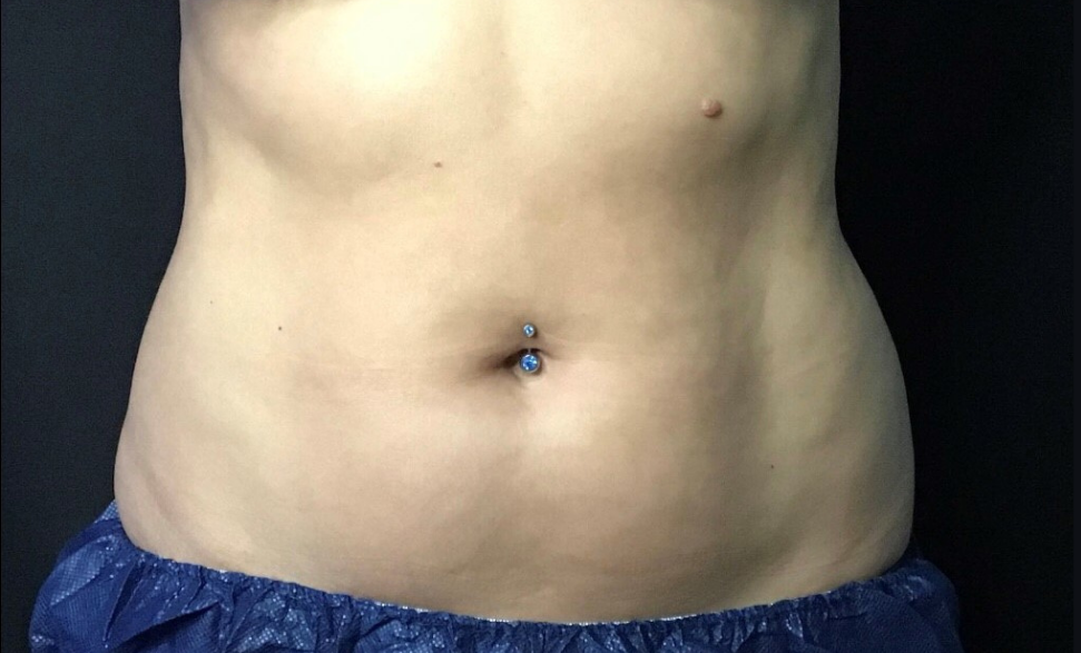 Coolsculpting® ELITE Case 29 Before Image