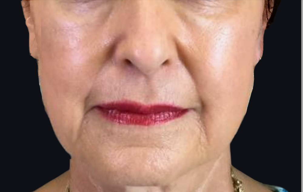 Dermal Fillers Case 29 Before Image