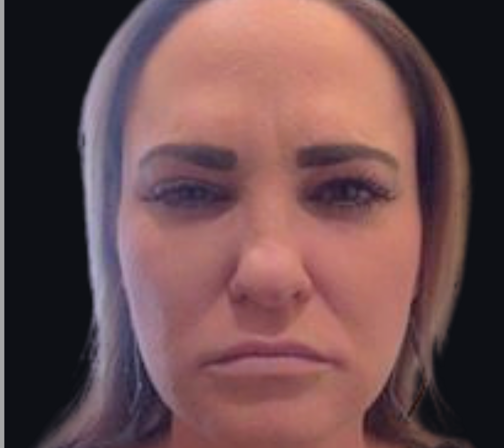Botox® / Dysport® Case 3 After Image