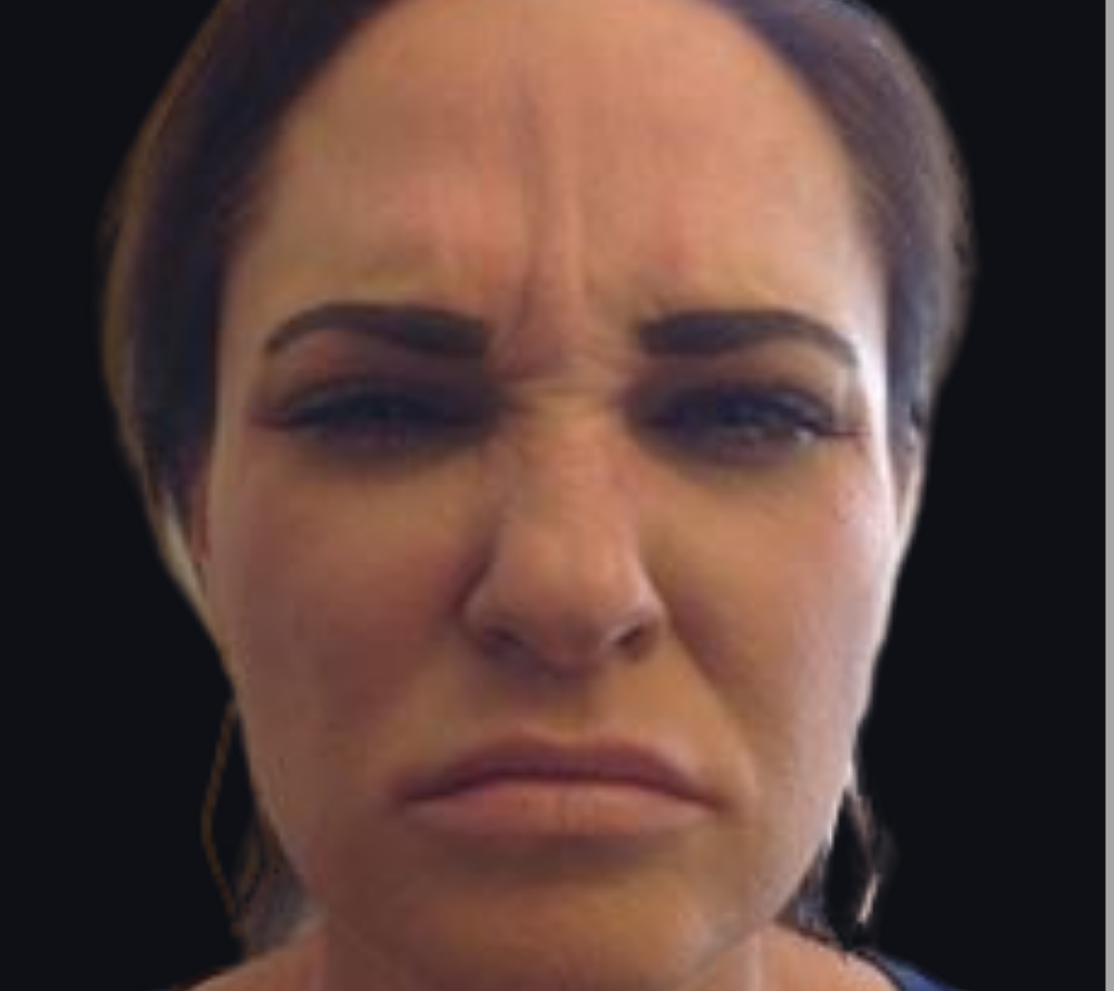 Botox® / Dysport® Case 3 Before Image