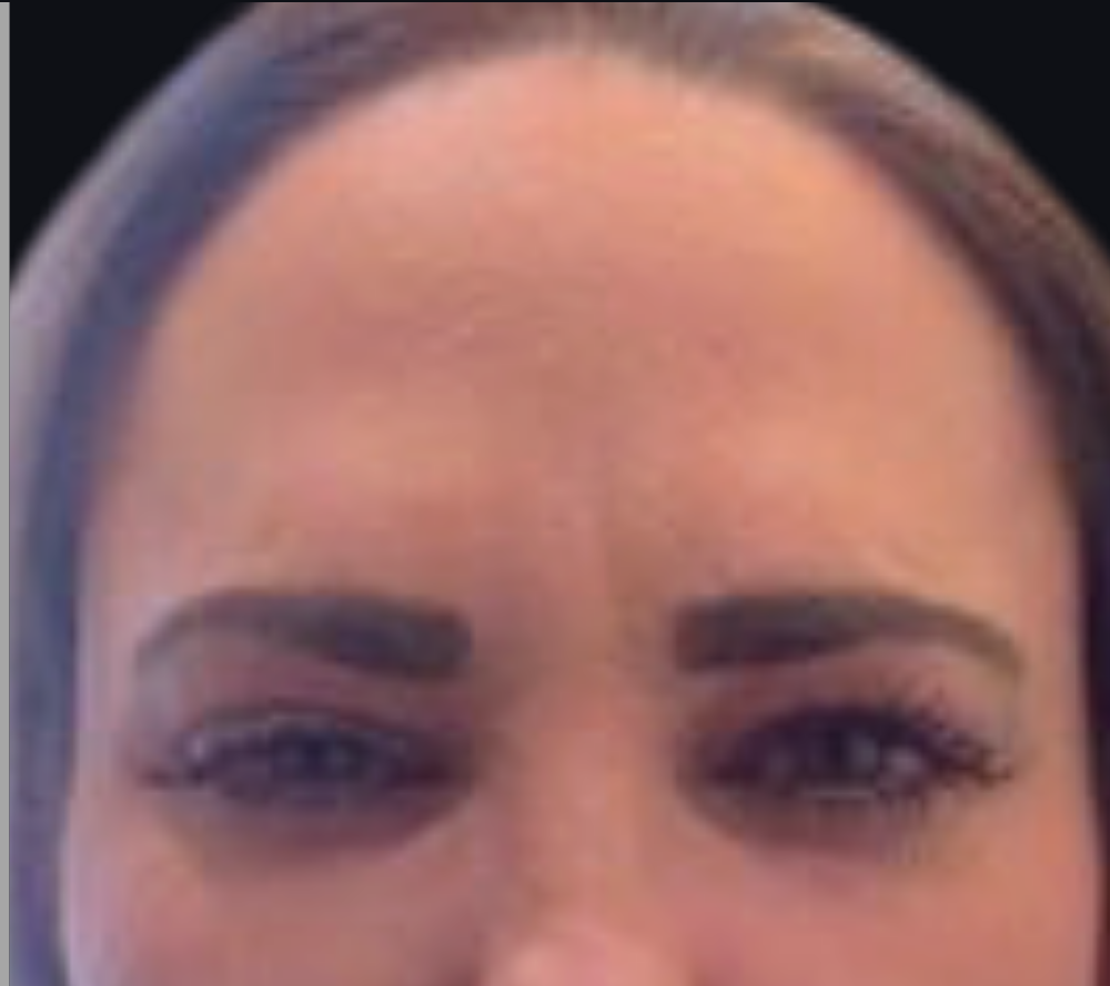 Botox® / Dysport® Case 3 After Image