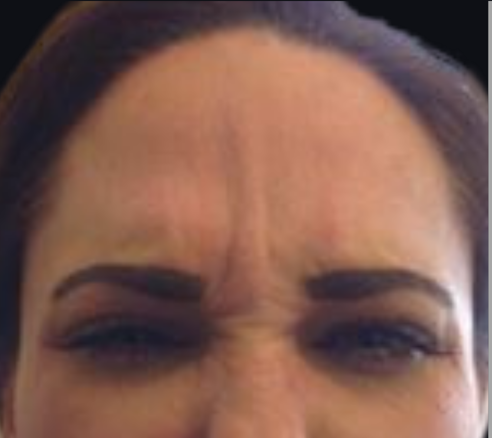 Botox® / Dysport® Case 3 Before Image