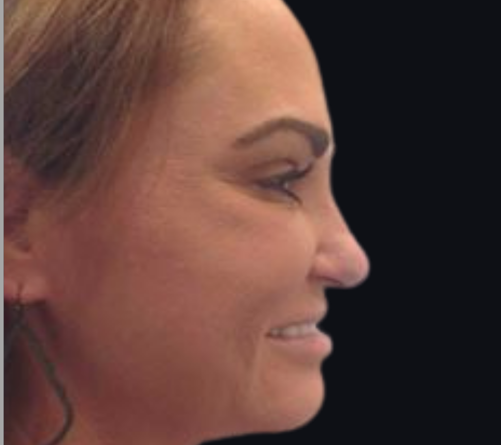 Botox® / Dysport® Case 3 After Image