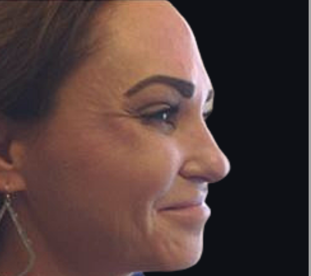 Botox® / Dysport® Case 3 Before Image