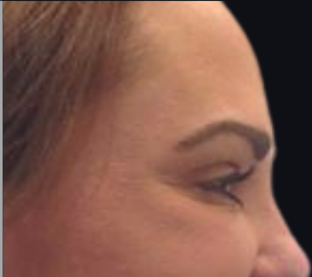 Botox® / Dysport® Case 3 After Image