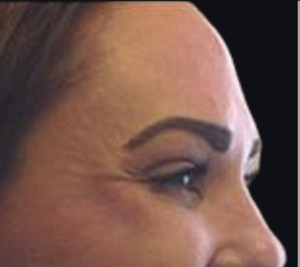 Botox® / Dysport® Case 3 Before Image