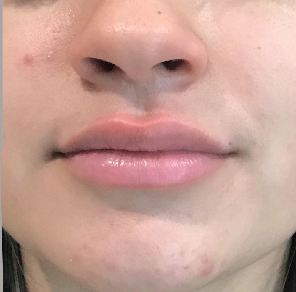 Lip Injections Case 3 After Image