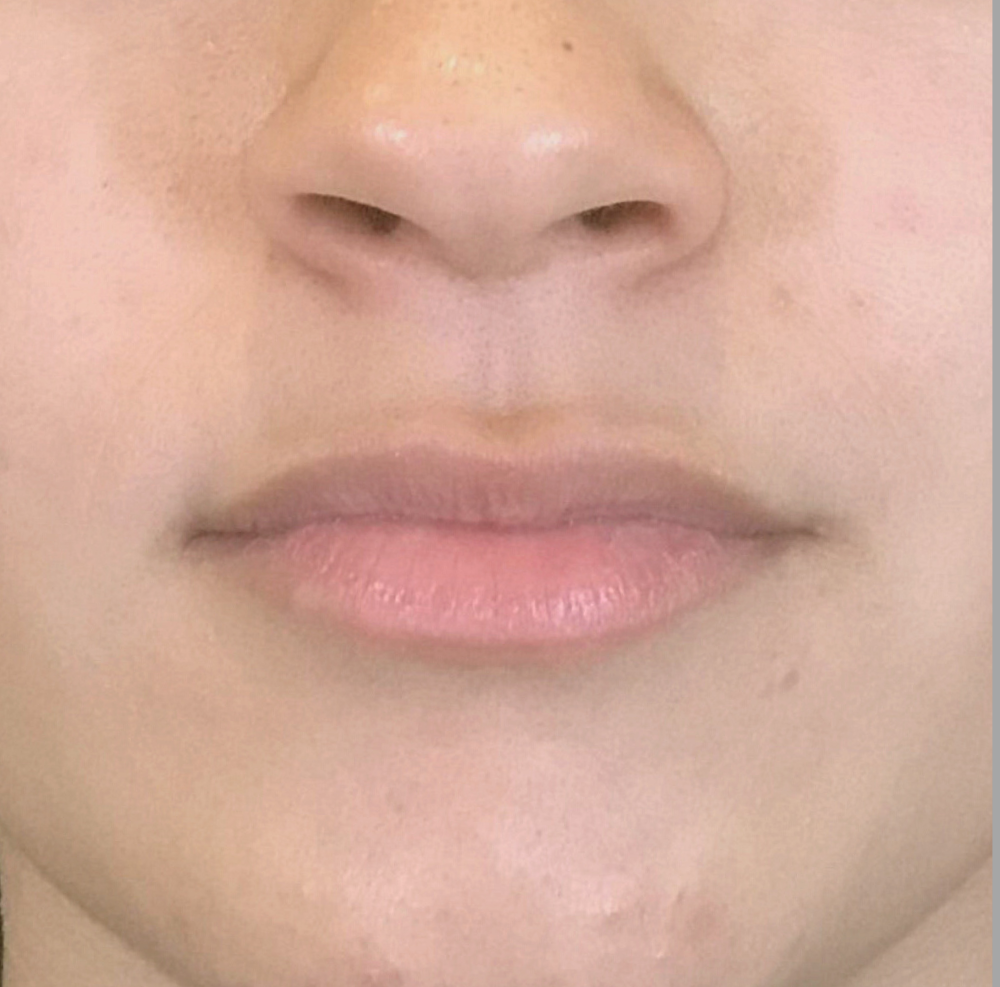 Lip Injections Case 3 Before Image