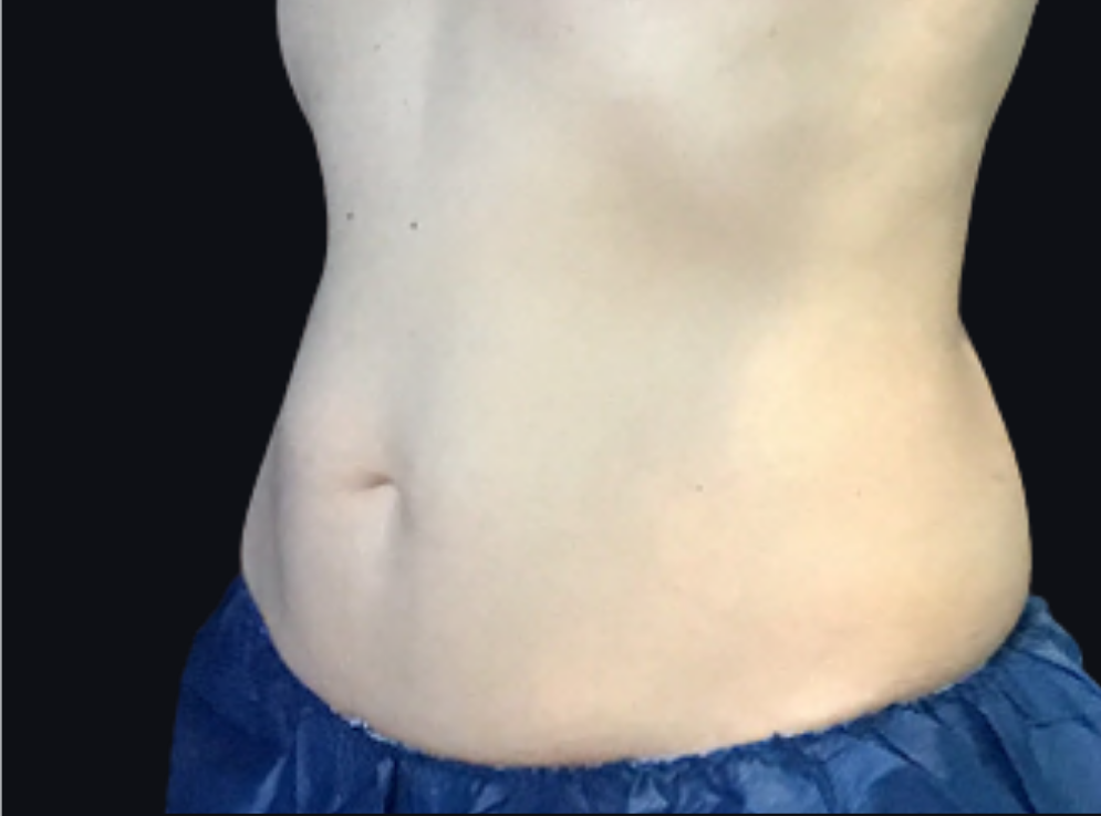 Coolsculpting® ELITE Case 30 After Image