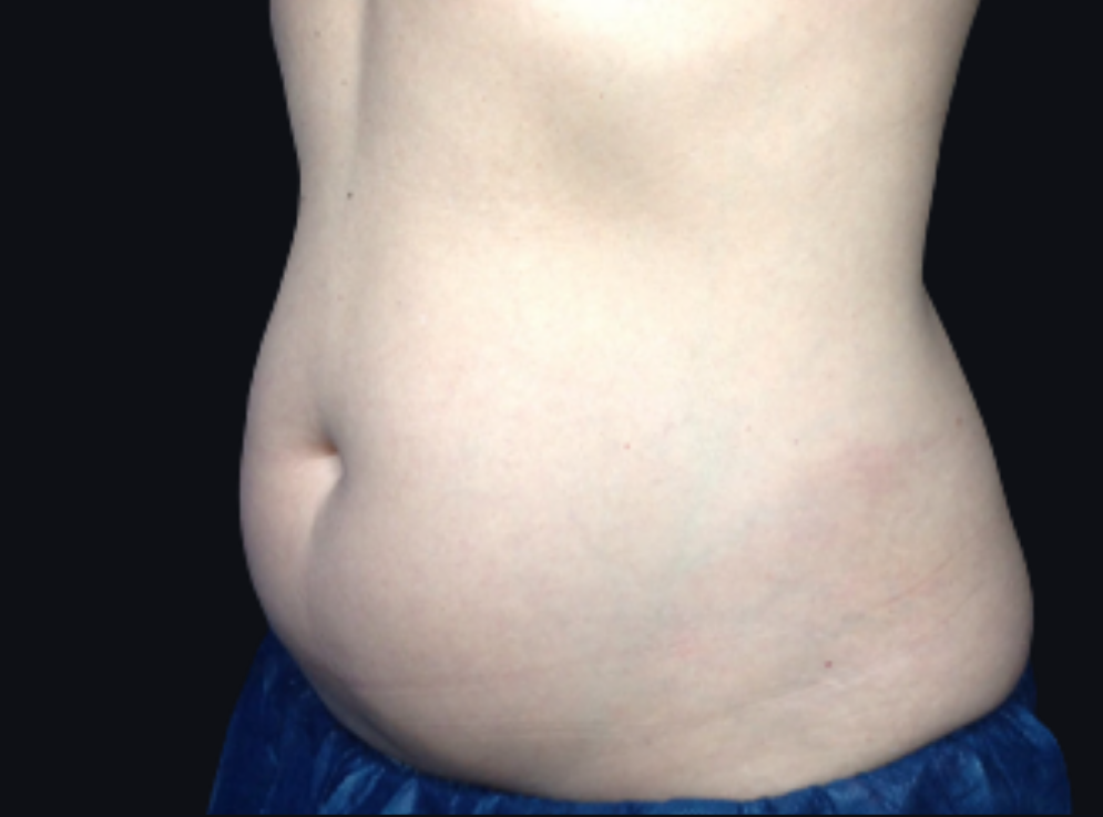 Coolsculpting® ELITE Case 30 Before Image
