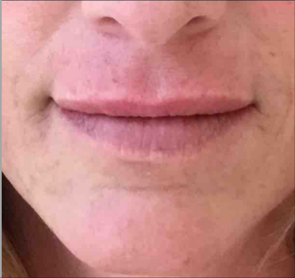 Lip Injections Case 30 After Image