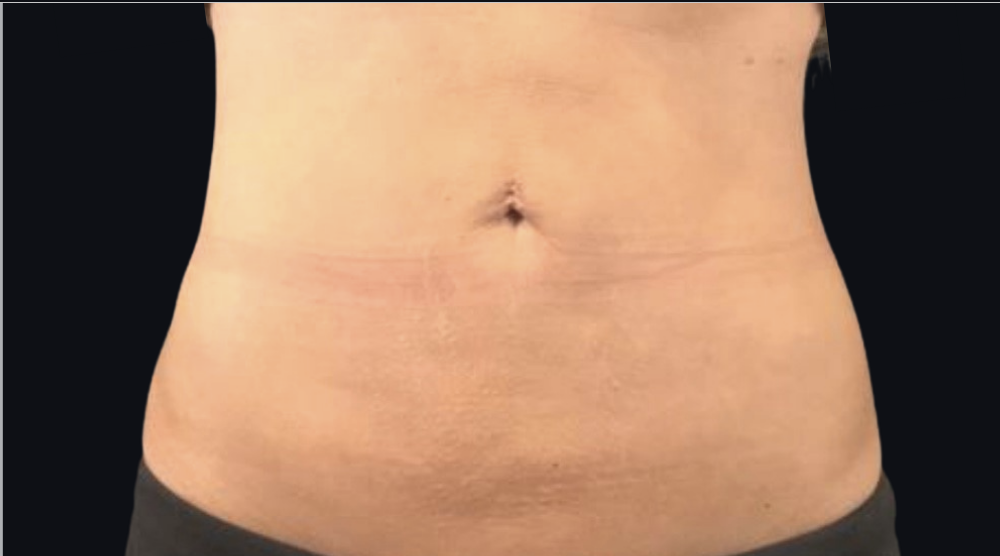 Coolsculpting® ELITE Case 31 After Image