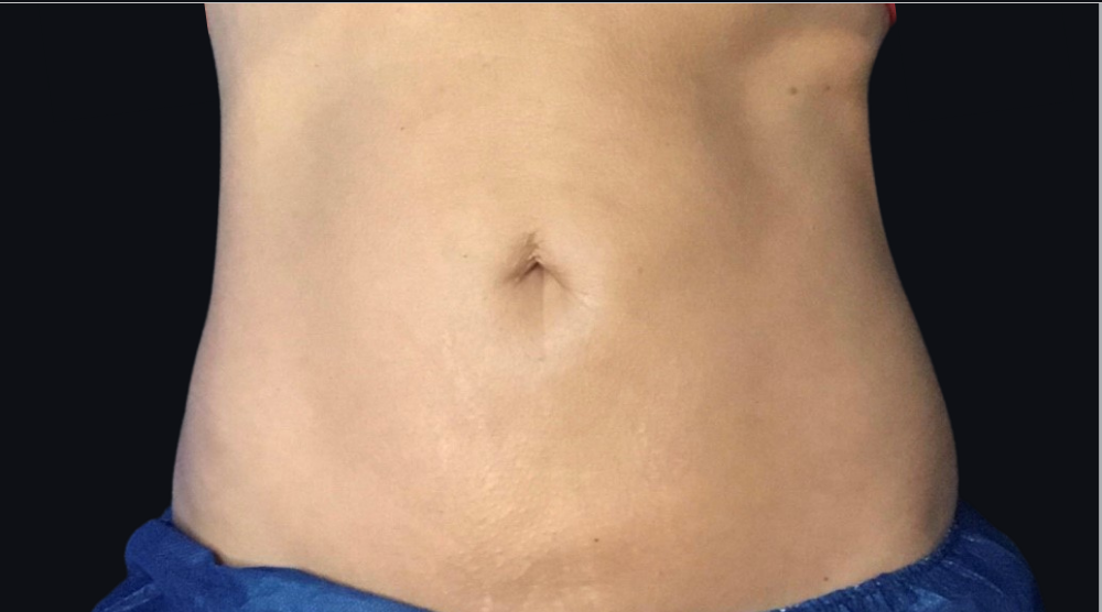 Coolsculpting® ELITE Case 31 Before Image