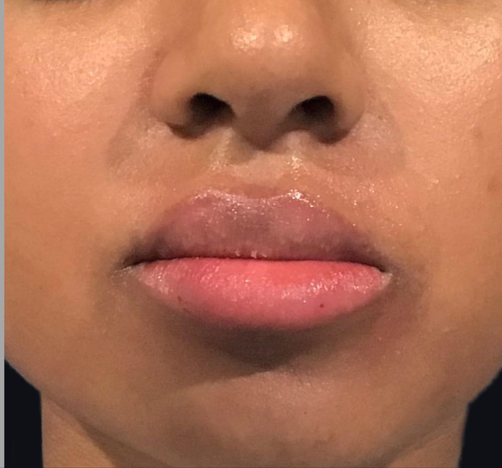 Lip Injections Case 31 After Image