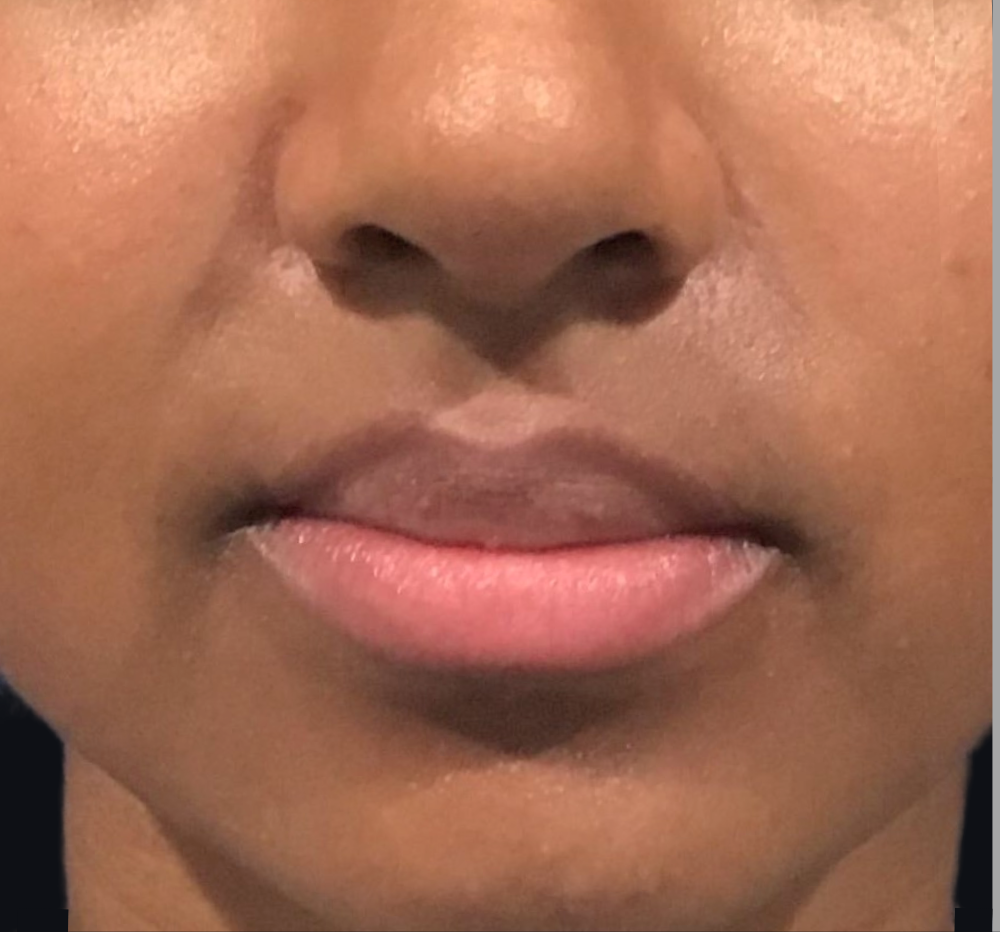 Lip Injections Case 31 Before Image