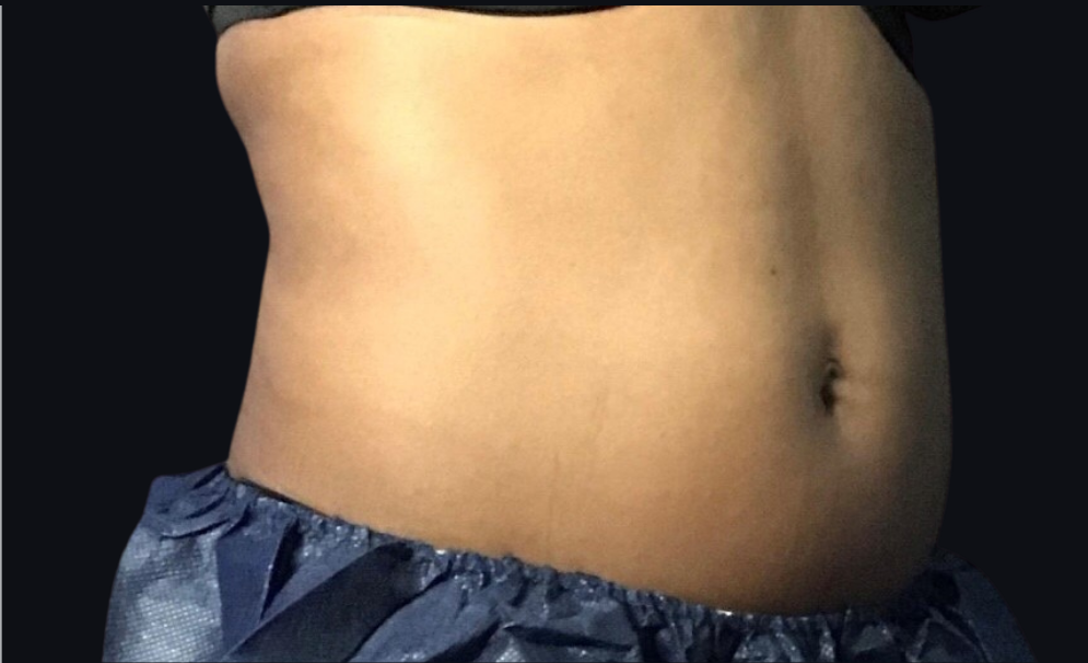 Coolsculpting® ELITE Case 32 After Image