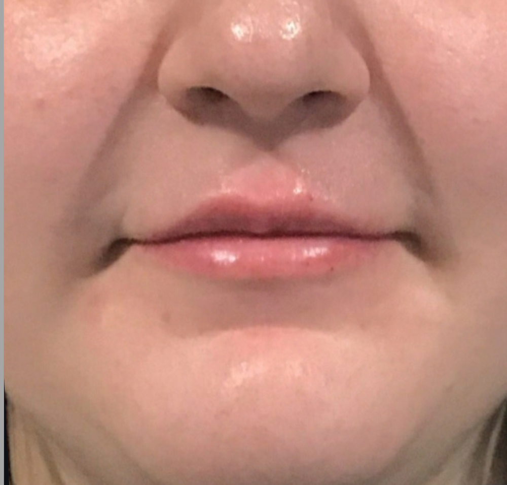 Lip Injections Case 32 After Image