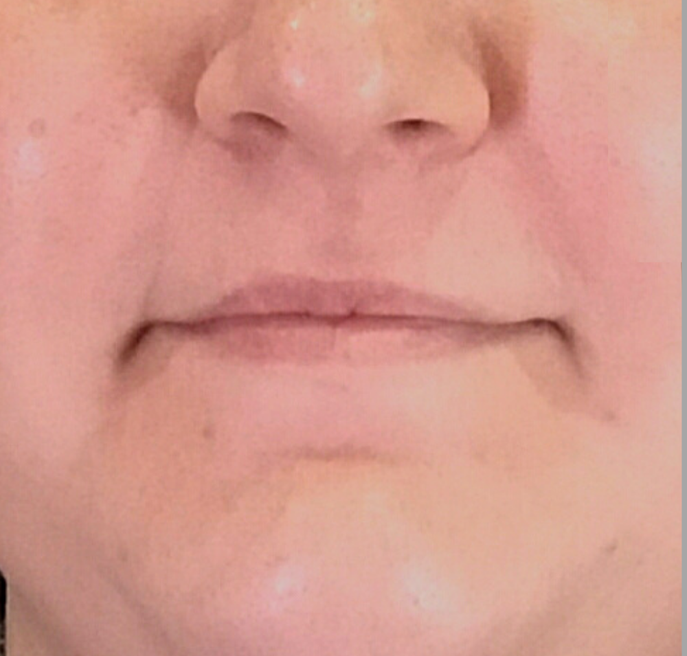 Lip Injections Case 32 Before Image