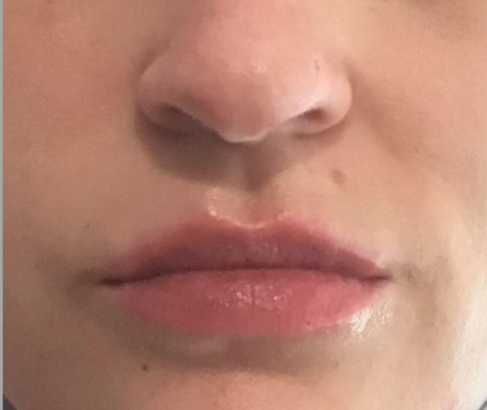 Dermal Fillers Case 32 After Image
