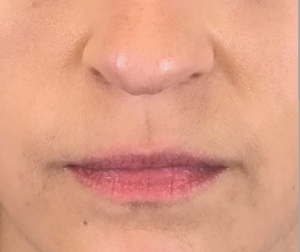 Dermal Fillers Case 32 Before Image