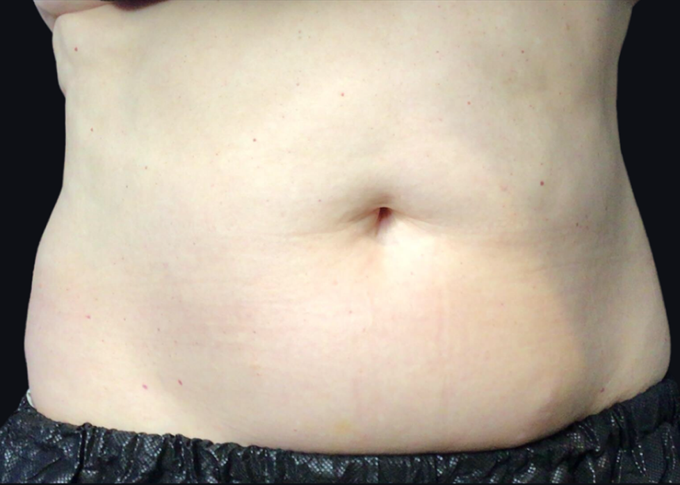 Coolsculpting® ELITE Case 33 Before Image