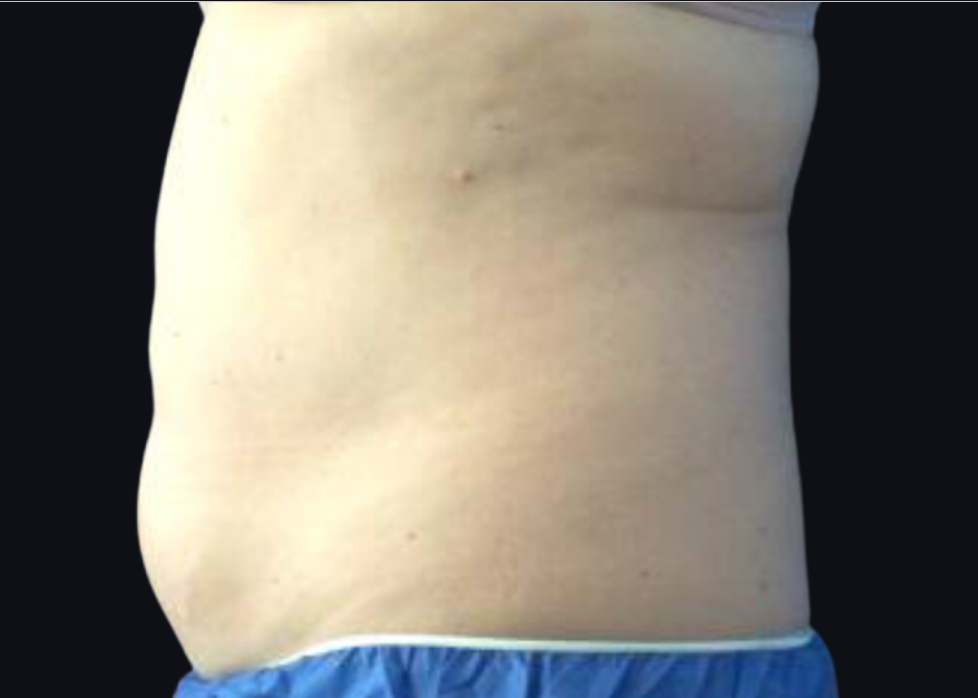 Coolsculpting® ELITE Case 33 After Image