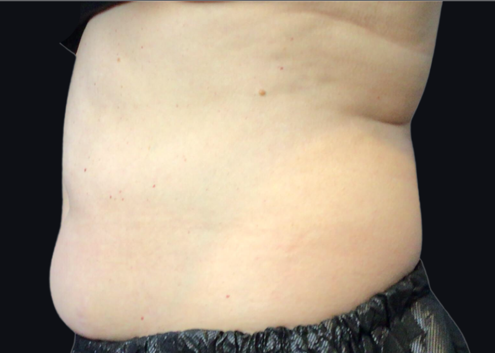 Coolsculpting® ELITE Case 33 Before Image
