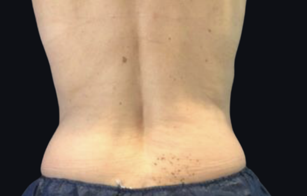 Coolsculpting® ELITE Case 34 After Image