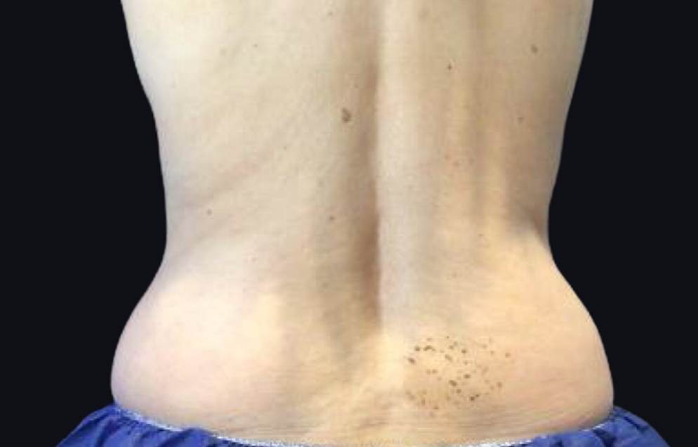 Coolsculpting® ELITE Case 34 Before Image