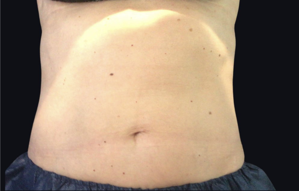 Coolsculpting® ELITE Case 34 After Image