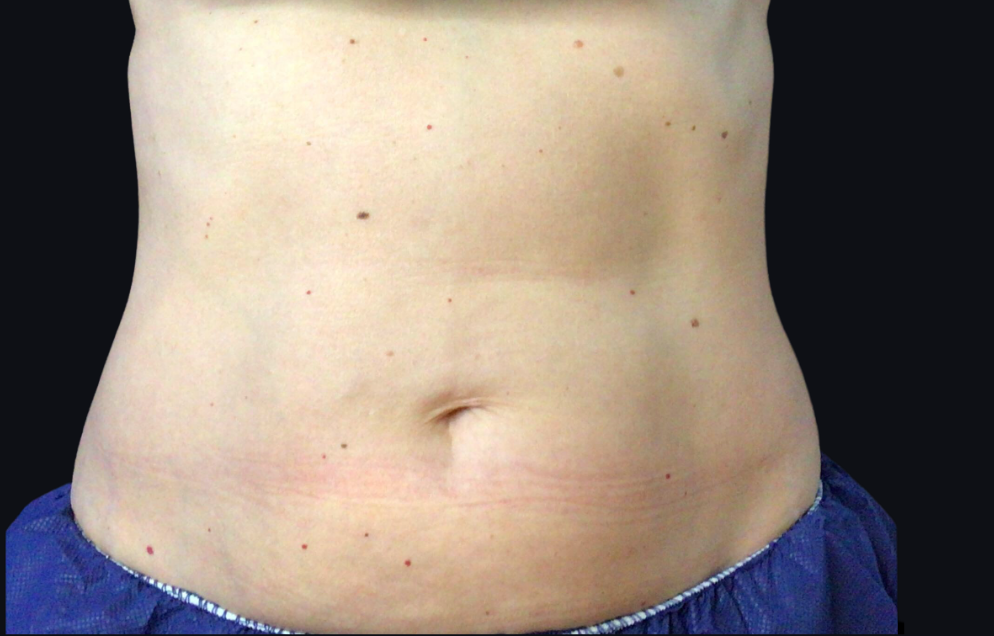 Coolsculpting® ELITE Case 34 Before Image